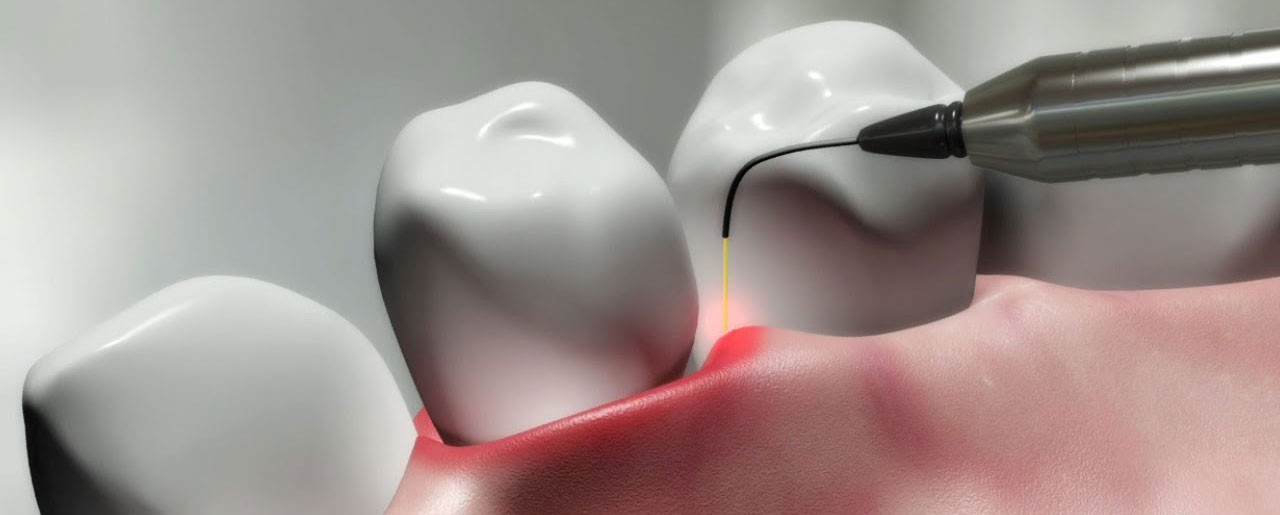 جراحی لثه با لیزر